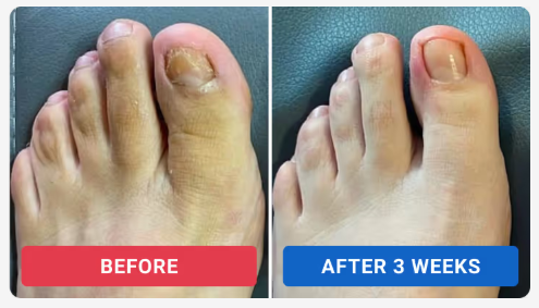 Orivelle Fungus Pen Before and After